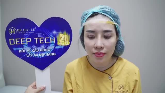 Sự biến hóa thần kỳ trước và sau khi sửa mí DEEP TECH20 tại Dr.Hải Lê!