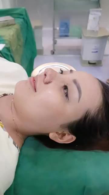 DÁNG MŨI TỰ NHIÊN SAU KHI ĐƯỢC DR.HOẠT SỬA LẠI