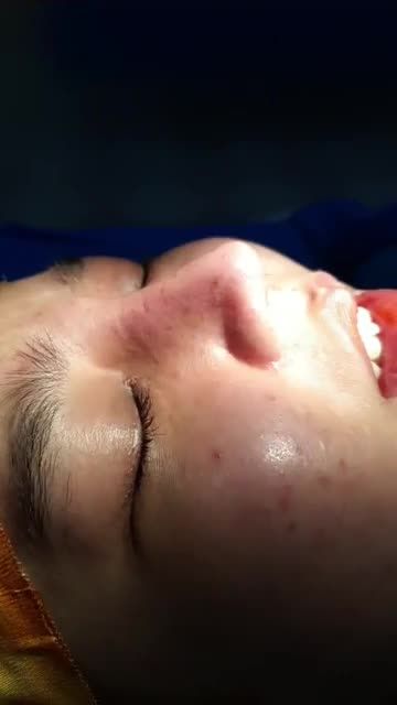 Nâng mui sụn tai 2 lớp Dáng Lline cao tây Cắt cánh mũi plasma