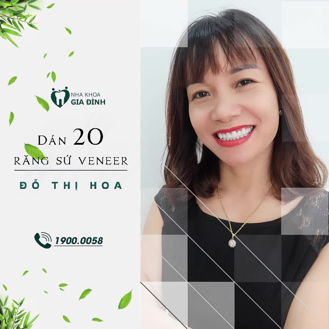 DÁN SỨ VENEER LẤY LẠI NHAN SẮC THUỞ ĐÔI MƯƠI