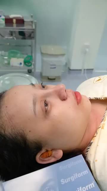 NÂNG MŨI SỤN SURGIFORM - DẪN ĐẦU XU HƯỚNG NÂNG MŨI 2020