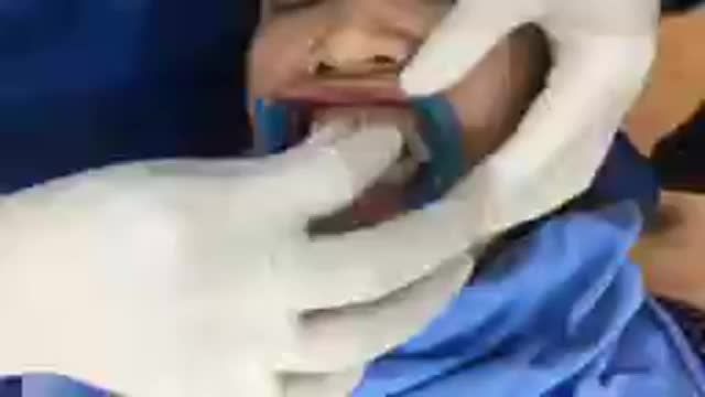 Gắn mắc cài cho chị Chuyên tại Nha Khoa Thuỳ Anh.