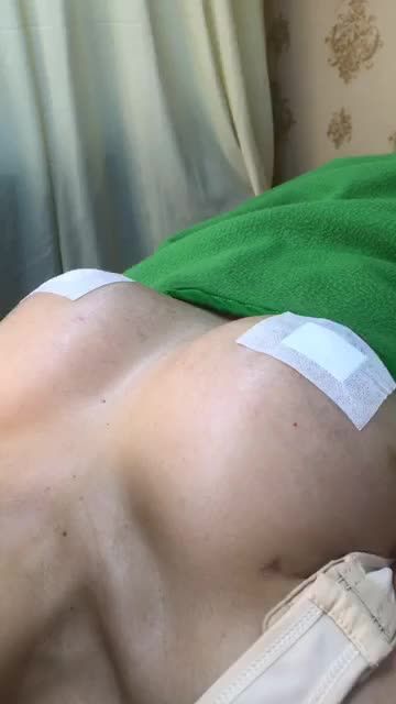 Nâng Ngực Nội Soi chân không kết hợp Treo Tuyến và Thu nhỏ đầu ngưc.