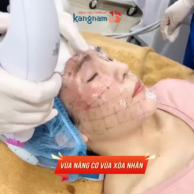 THERMAGE FLX - Xóa nhăn  Không phẫu thuật  Thấy ngay kết quả!