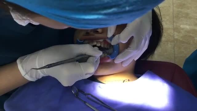 Gắn mắc cài chỉnh nha cho chị Nguyễn Thị Anh.