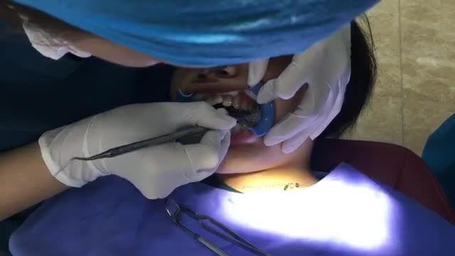 Gắn mắc cài chỉnh nha cho chị Nguyễn Thị Anh.