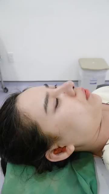 MŨI CẤU TRÚC - SỰ LỰA CHỌN HOÀN HẢO KHI NÂNG MŨI