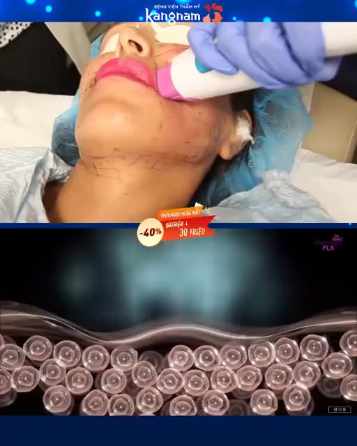 Thách thức làn da lão hóa - Cải thiện 90% sau khi làm THERMAGE FLX