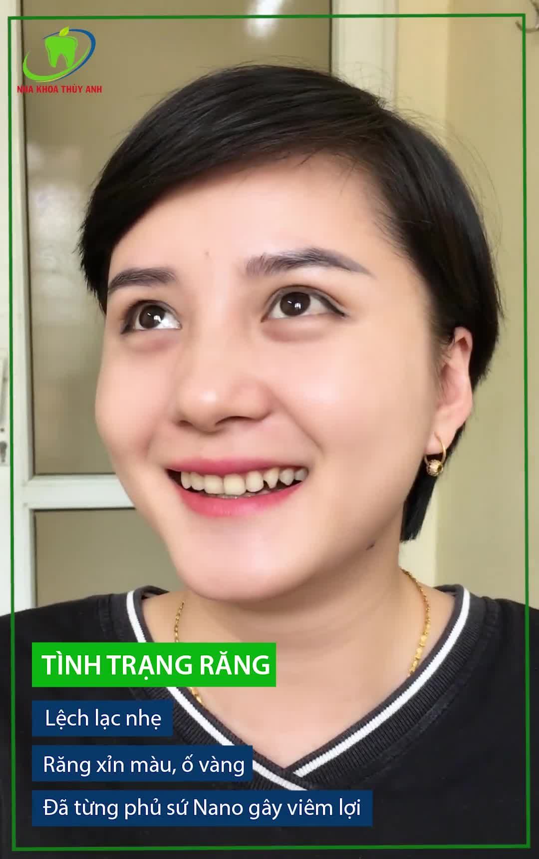 Thời điểm tốt nhất để bọc răng sứ là khi nào