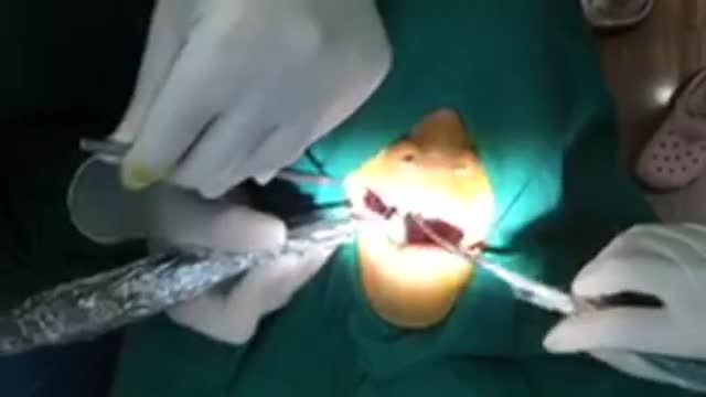 Cấy chân răng nhân tạo Implant cho khách hàng tại Nha Khoa Thuỳ Anh.