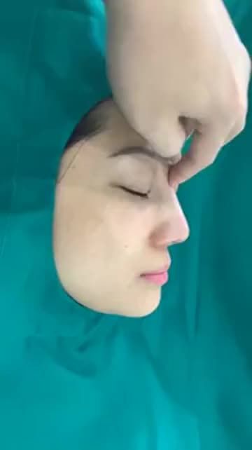 Nâng mũi cao tự nhiên