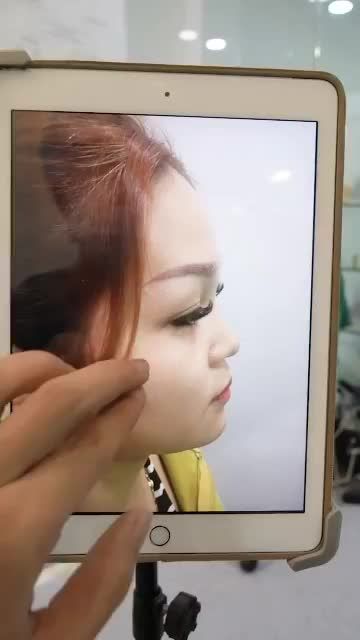 NÂNG MŨI CẤU TRÚC KẾT HỢP ĐỤC XƯƠNG VỪA MỚI THỰC HIỆN XONG