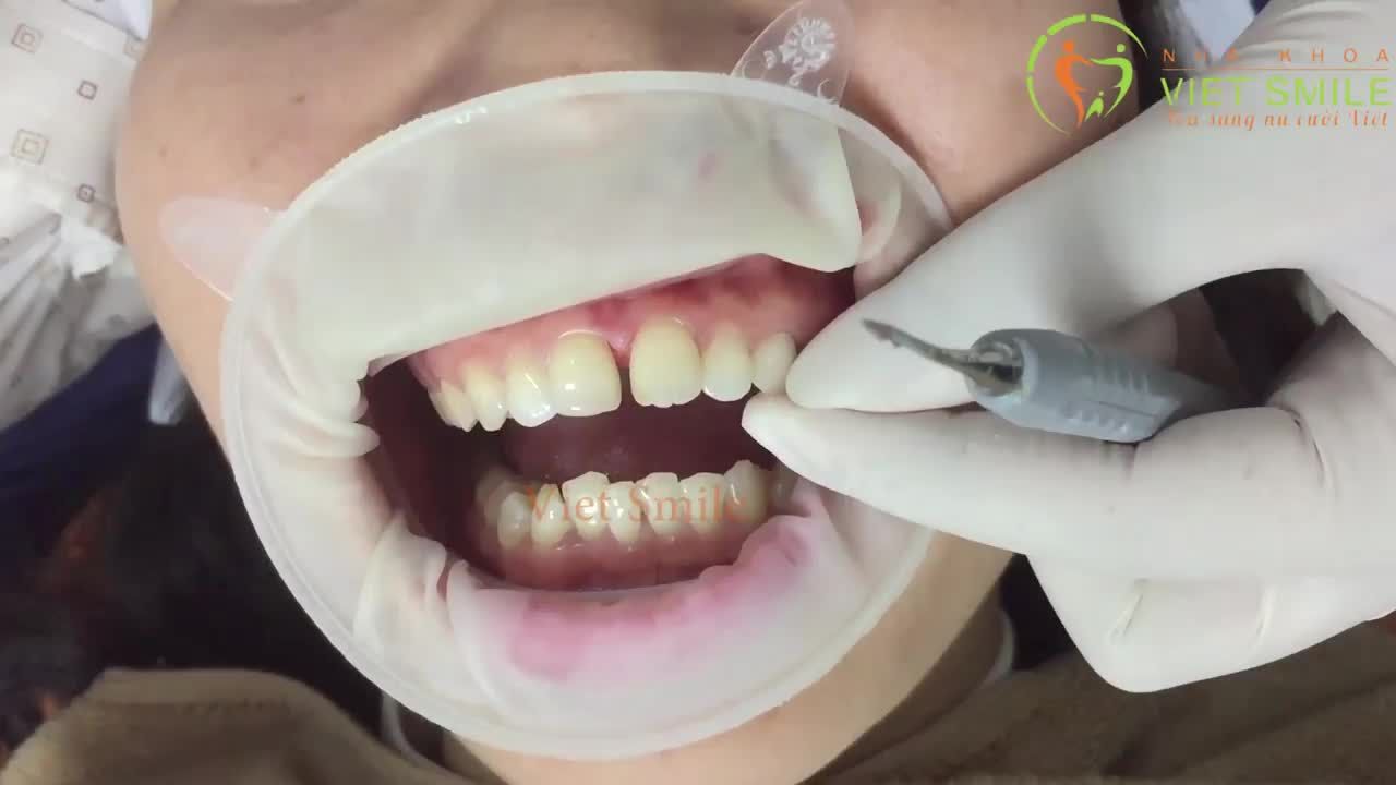 Thưa chỗ nào đóng khe thưa chỗ đó!