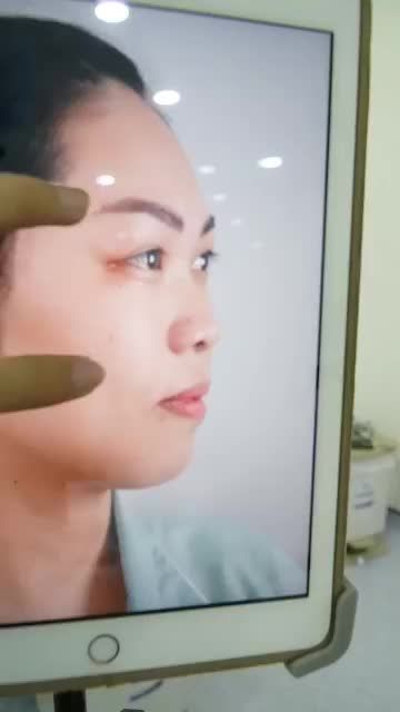 MŨI CẤU TRÚC SỤN SURGIFORM VỪA THỰC HIỆN XONG - MŨI CAO HÀI HÒA