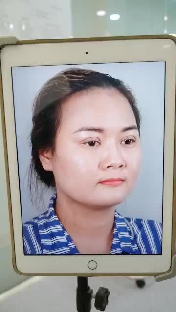 NÂNG MŨI CẤU TRÚC TẠI DR.HOẠT - MŨI ĐẸP AN TOÀN