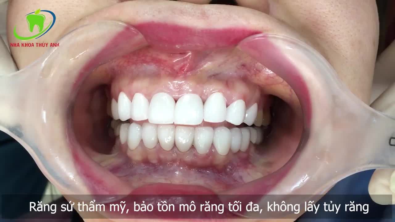 RĂNG BỊ NHIỄM MÀU TETRACYLIN VÀ CÁCH KHẮC PHỤC.