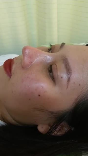 Nâng mũi bán cấu trúc Dáng Lline cao tây Quá đẹp
