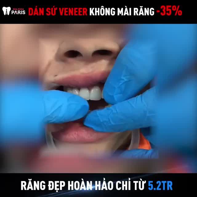 MẶT DÁN SỨ VENEER - Không mài răng, bảo tồn răng thật tối đa