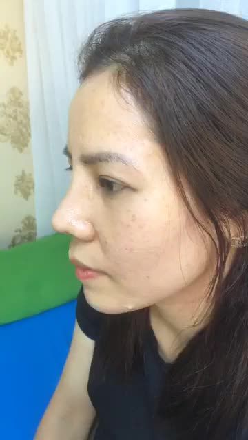 Nâng mũi Bán Cấu Trúc Sụn Tai  Đẹp hoàn hảo sau 15 ngày cùng Bác Sĩ KỲ Y Dược