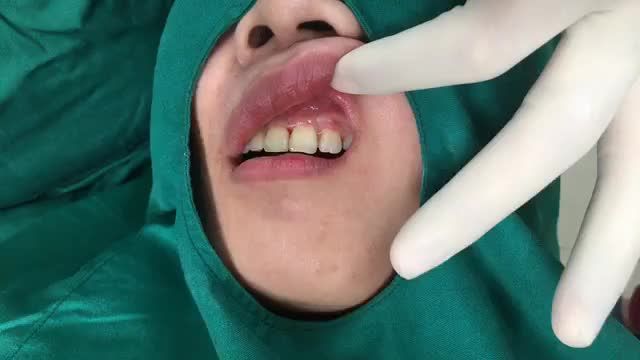 PHẪU THUẬT CƯỜI HỞ LỢI TẠI NHA KHOA THÙY ANH