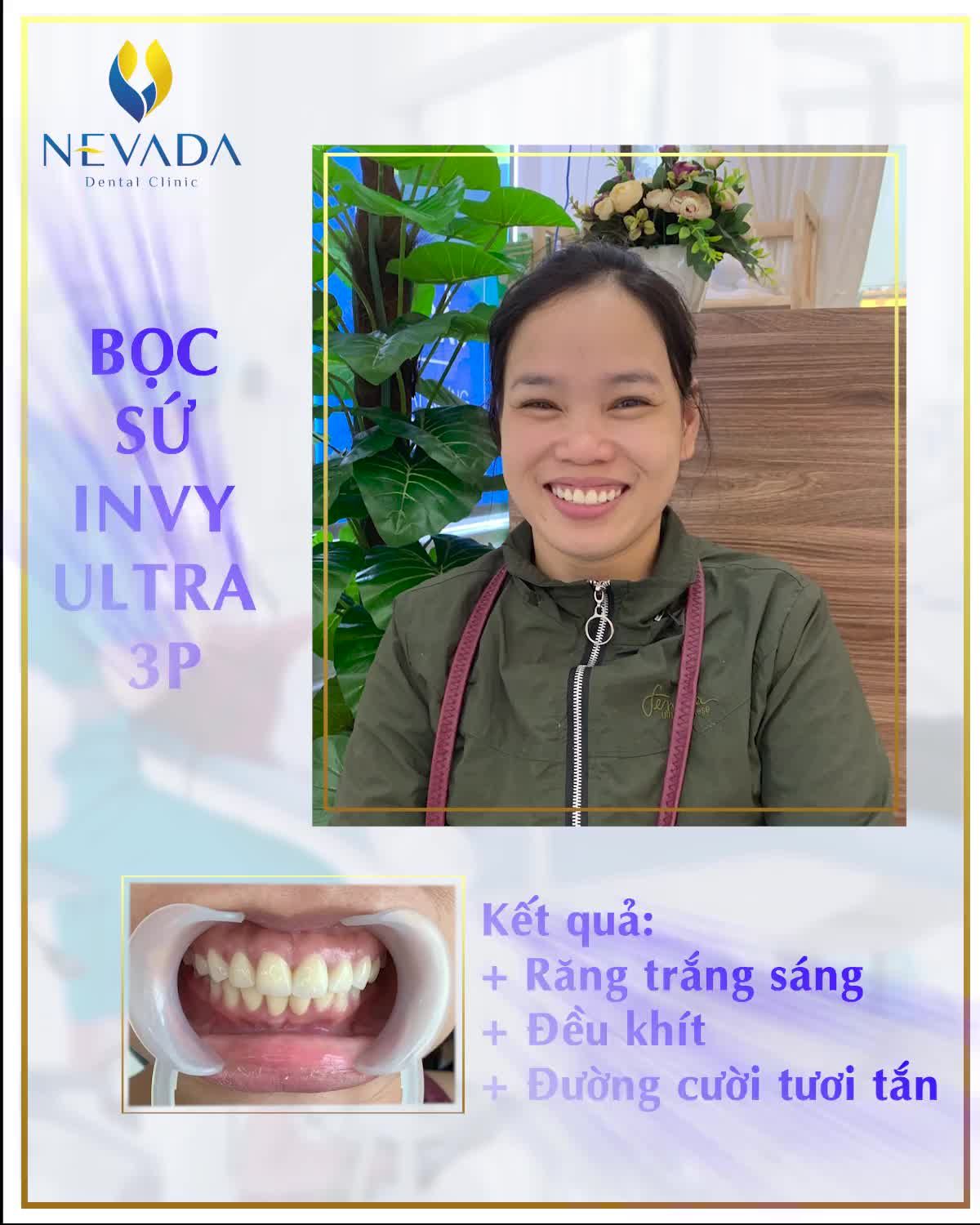 LỘT XÁC NỤ CƯỜI SAU 2 BUỔI HẸN