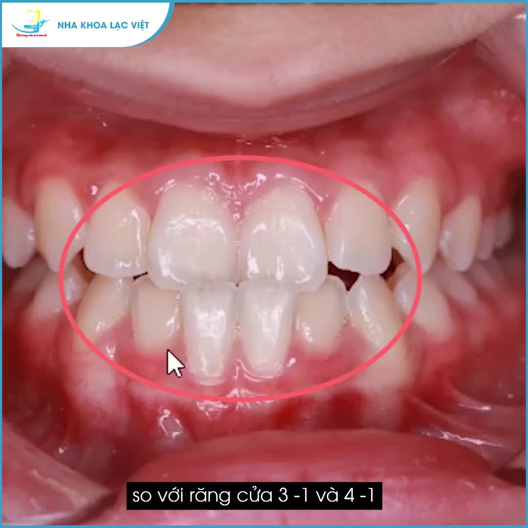 NIỀNG RĂNG điều trị KHỚP CẮN NGƯỢC thế nào