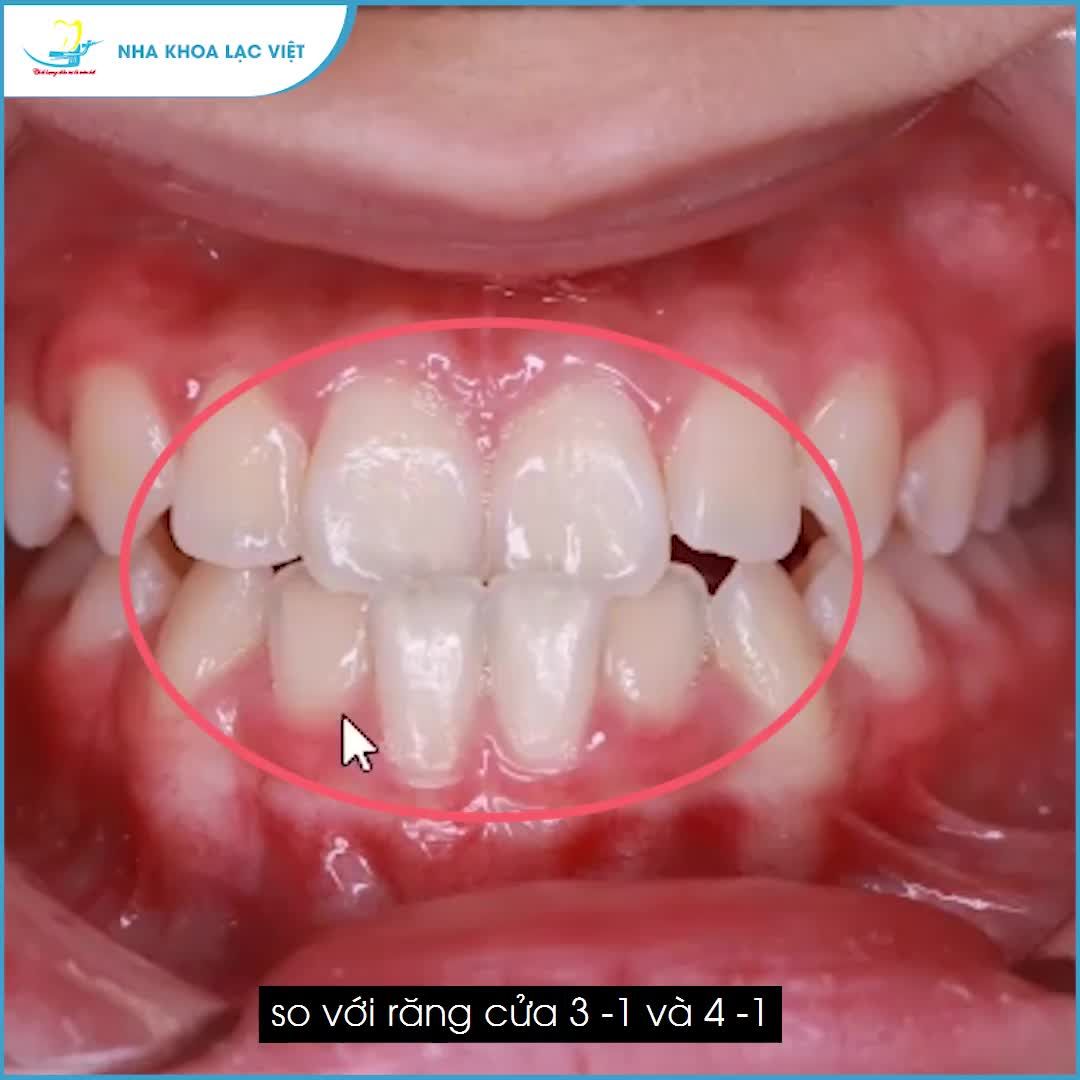 NIỀNG RĂNG điều trị KHỚP CẮN NGƯỢC thế nào