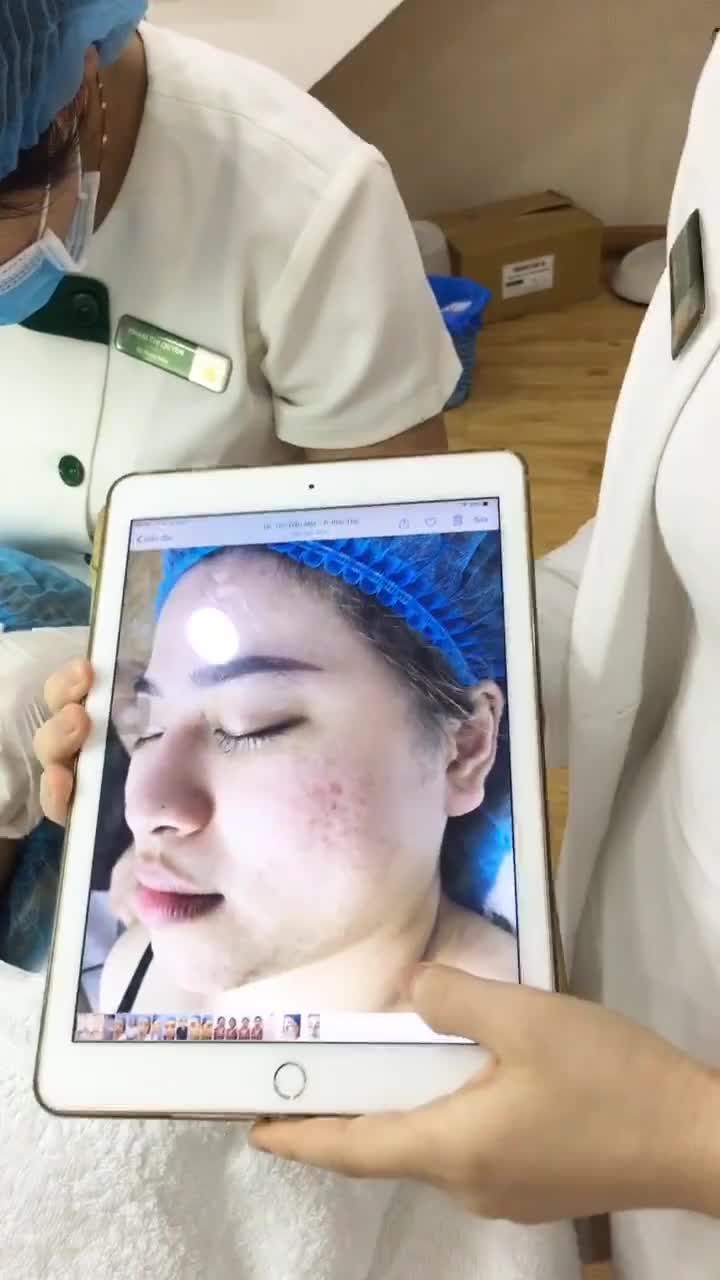 Đánh bay mụn ẩn, mụn cám với CN Acne Remove