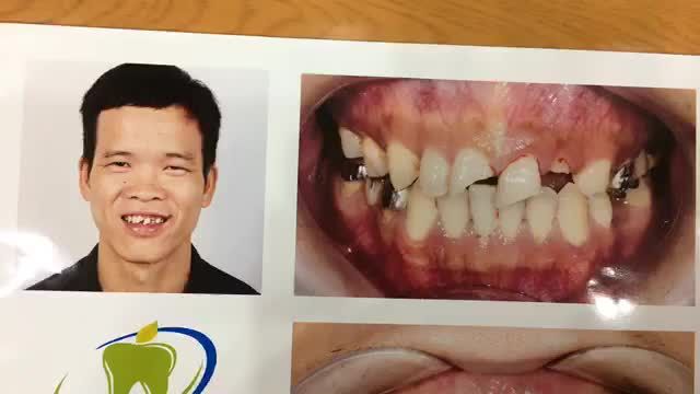 Lắp răng sứ thẩm mỹ cho anh An.
