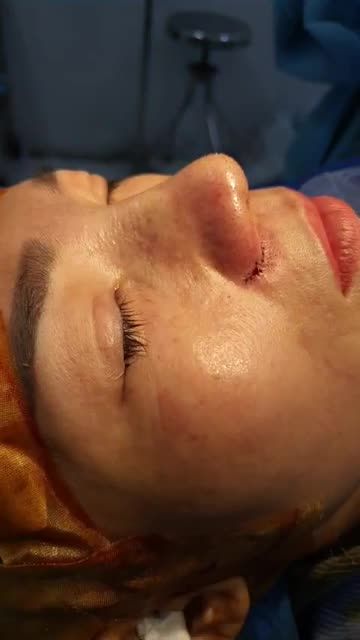 Nâng mũi bán cấu 2 lớp