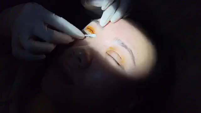 Quá trình cắt mí sau 7 ngày tại Dr.Hải Lê.