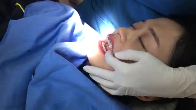 Tháo mắc cài cho bạn Thu Hiền tại Nha Khoa Thuỳ Anh