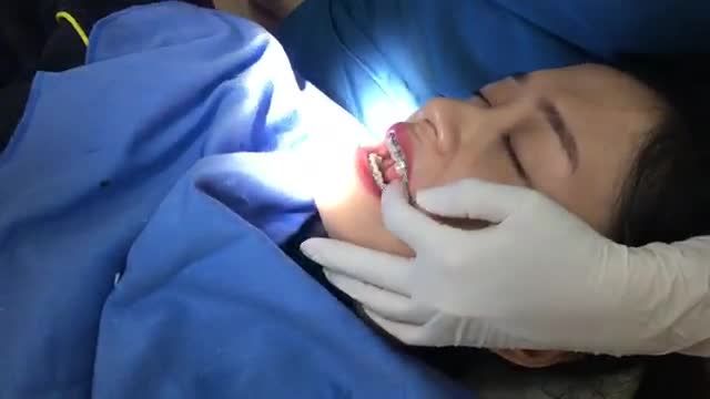 Tháo mắc cài cho bạn Thu Hiền tại Nha Khoa Thuỳ Anh