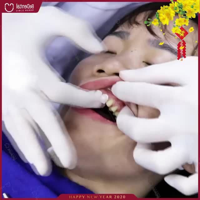 KHÔNG MÀI NHỎ RĂNG BỀN ĐẸP TỚI 50 NĂM