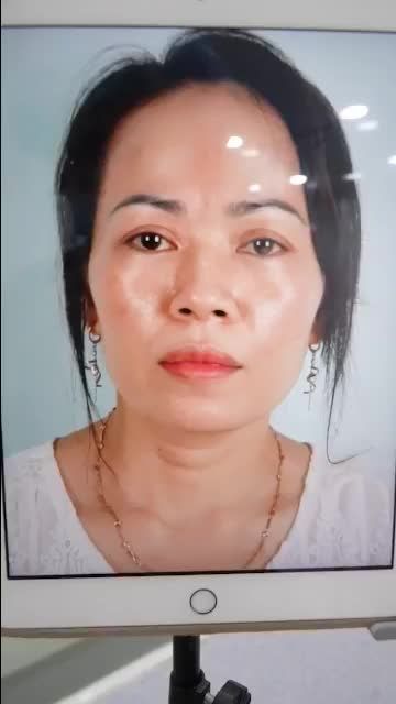 THAY ĐỔI NHƯ MONG MUỐN SAU 45P NÂNG MŨI CẤU TRÚC TẠI DR.HOẠT