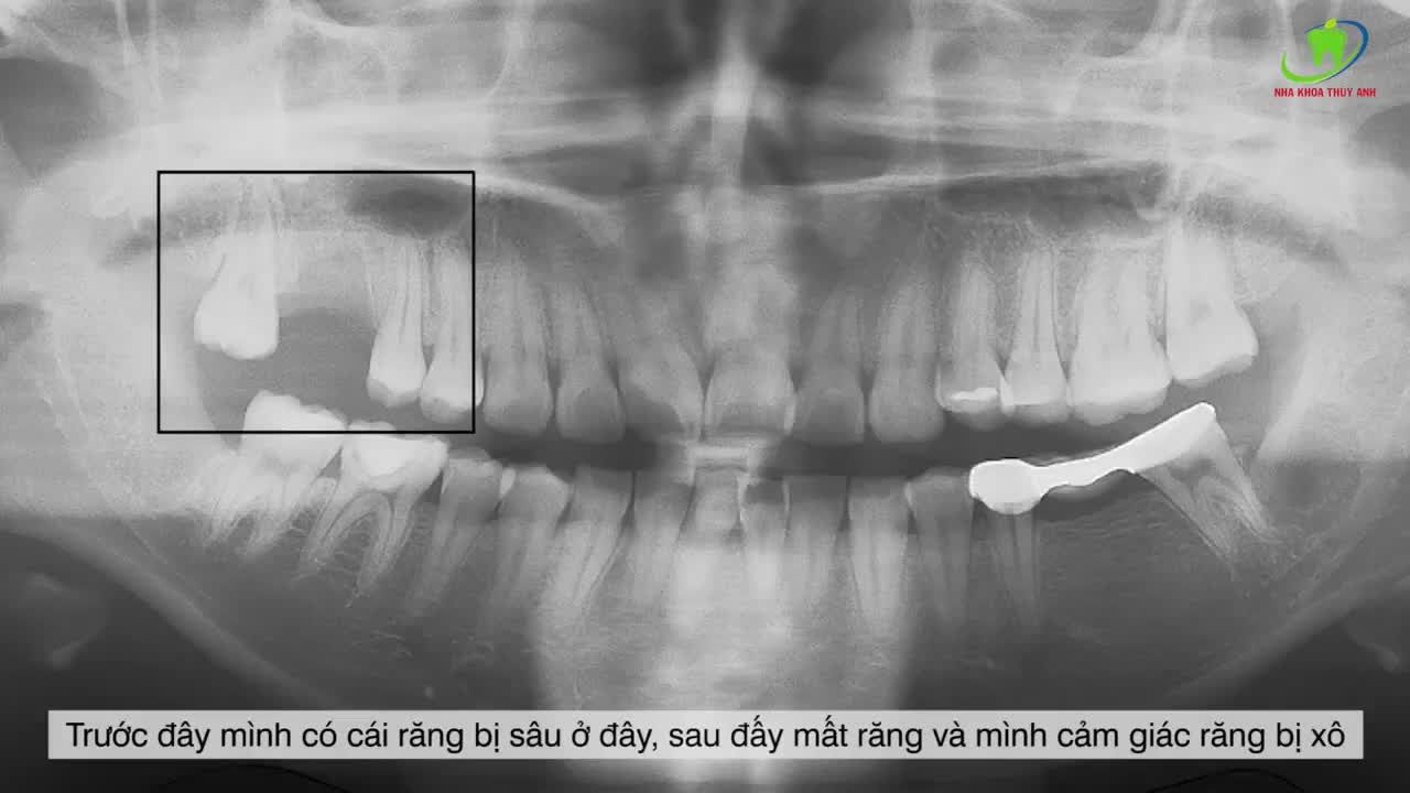CẮM CHÂN RĂNG IMPLANT MÀ CẢM GIÁC NHƯ CHƯA CẮM VẬY
