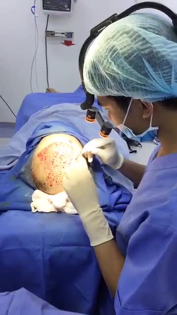 Cận cảnh quá trình lấy nang tóc tại BVTM Đông Á 212 Kim Mã - HN với số lượng hơn 1000 nang tóc