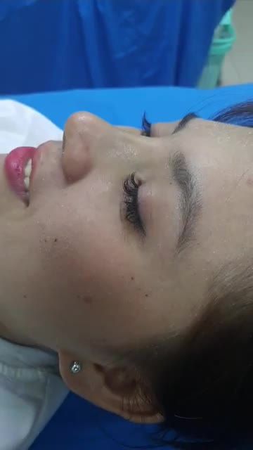 Nâng mũi bán cấu trúc Dáng Sline kết hợp Lline Quá đẹp sau 15 ngày tuổi