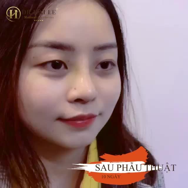 TỰ TIN HƠN với NÂNG MŨI DEMI 5D tại DR.HẢI LÊ!  NÂNG MŨI chỉ 11.8TR