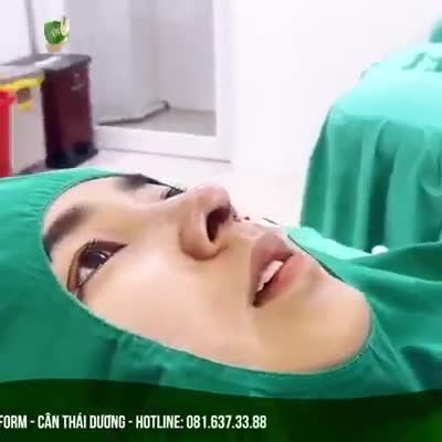 Khách hàng sau khi nâng mũi siêu cấu trúc sụn surgiform kết hợp bọc cân cơ thái dương.