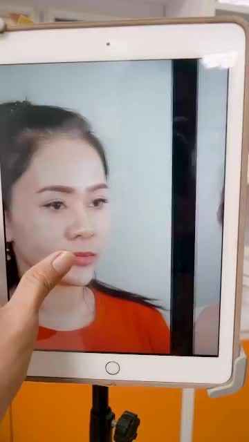 NÂNG MŨI CẤU TRÚC SAU 1 THÁNG SẼ THAY ĐỔI NHƯ THẾ NÀO - XEM NGAY KẾT QUẢ