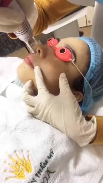 Cận cảnh trị nám bằng công nghệ Melas Reno tại Thẩm Mỹ Viện Đông Á.Sạch nám tới 90%, mà lại không hề đau rát và cũng không để lại sẹo đâu ạ!