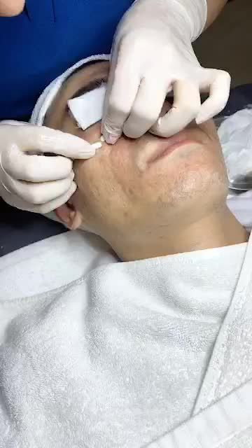 Mụn ẩn, mụn bọc, mụn cám... đi ngay trong vòng 1 nốt nhạc với công nghệ điều trị mụn Nano tại BVTM Kangnam