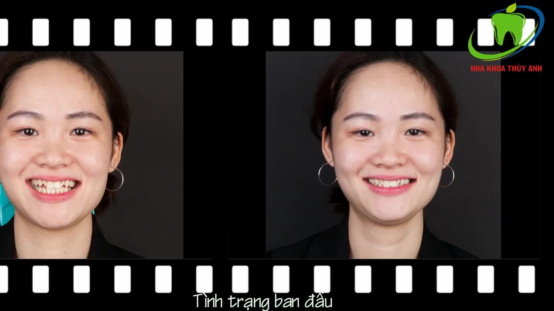 BỌC RĂNG SỨ - THU HÚT MỌI ÁNH NHÌN QUA NỤ CƯỜI CỦA BẠN