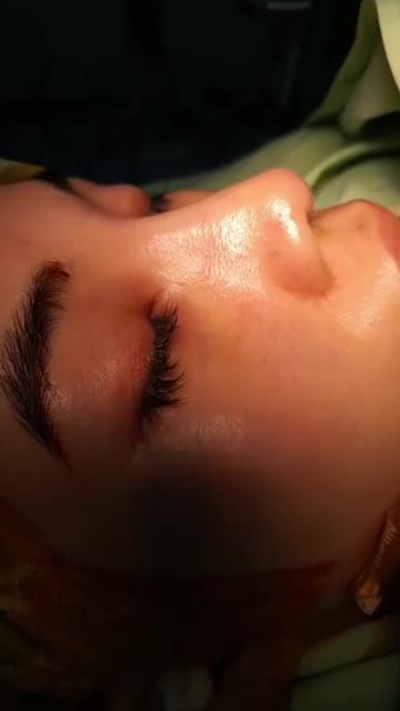 Nâng mũi bán cấu trúc 2 lớp
