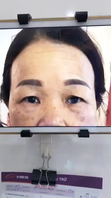 Quá trình phẫu thuật treo cung mày 15 phút.