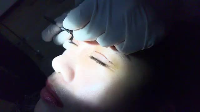 Cắt chỉ mí mắt sau 7 ngày tại Dr.Hải Lê