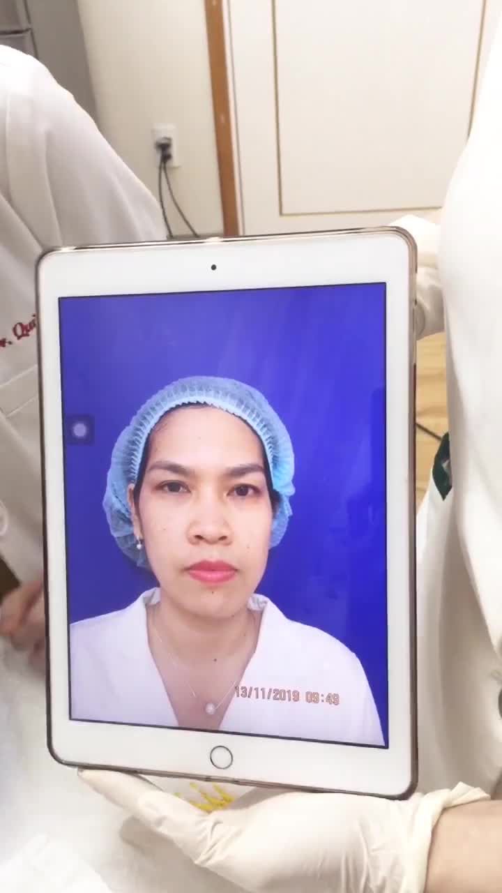 Điều trị nám và tàn nhang của khách hàng bằng CN Melas Reno