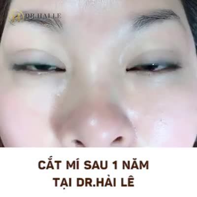 Tự tin với NẾP MÍ HOÀN HẢO sau 1 năm Cắt mí tại DR.HẢI LÊ!