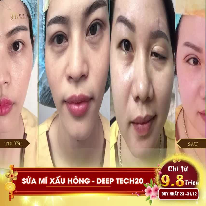 Tuần vàng DEEP TECH20 - Sửa mí đón Tết, giai nhân khởi sắc